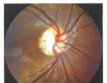 Method of surgical treatment of the optic disc fossa Text of a scientific work on the topic “Our experience in the surgical treatment of the optic disc fossa”