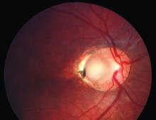 Klinička optička koherentna tomografija: optička jama